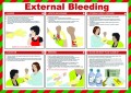 External Bleeding